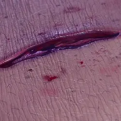 open wound type: Lacerations