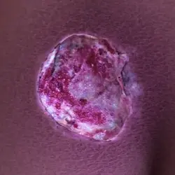 open wound type: Pressure ulcers