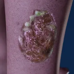 open wound type: Venous leg ulcers